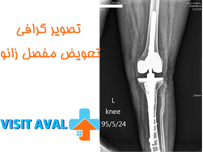 تصویر گرافی تعویض مفصل زانو می‌تواند نشان دهنده مراحل مختلف این جراحی پیچیده باشد و به پزشکان و بیماران کمک کند تا بهترین تصمیم را برای درمان مشکلات زانویی بگیرند.