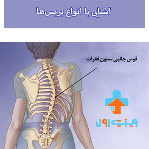 آشنایی با انواع بریس‌ها