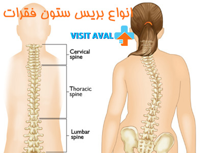انواع بریس ستون فقرات