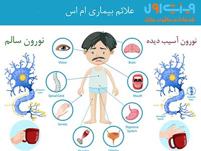 یکی از علائم رایج بیماری MS، اسپاسم‌های عضلانی است که می‌تواند باعث درد و محدودیت در حرکت شود.