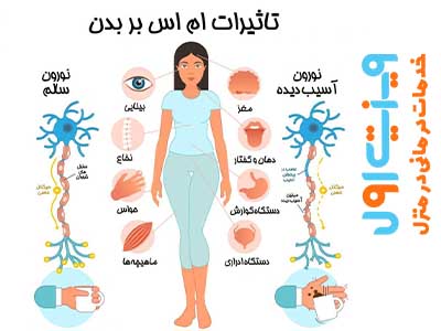 علت ابتلا به بیماری ام اس چیست؟