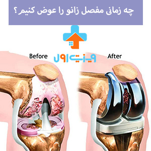 چه زمانی مفصل زانو را عوض کنیم؟