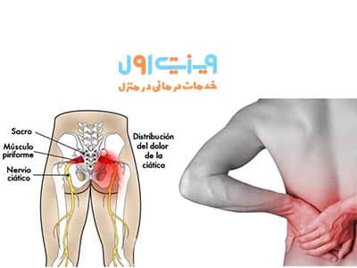درد سیاتیک یکی از شایع‌ترین انواع دردهای ستون فقرات است که از ناحیه کمر تا پاها امتداد یافته و باعث ناراحتی شدید می‌شود.