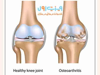 آرتروز مفصل زانو با افزایش سن شایعتر میشود و شایعترین علائم آن شامل درد، تورم و سفتی مفصل زانو است.