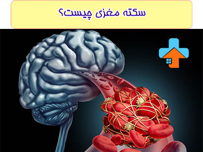 سکته مغزی یک وضعیت پزشکی اورژانسی است که ناشی از انسداد عروق خونی در مغز می‌شود.
