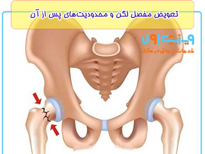 پس از تعویض مفصل لگن، محدودیت‌هایی در برنامه ورزشی و رژیم غذایی ممکن است بروز کند.