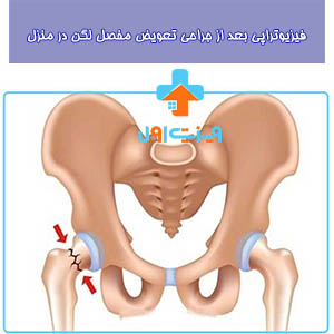 فیزیوتراپی بعد از جراحی تعویض مفصل لگن، با برنامه‌های خاصی که ارائه می‌دهد، به بهبود سریعتر و بازگشت به فعالیت‌های روزمره کمک می‌کند.