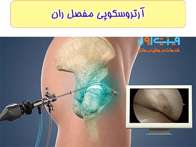 چنان چه مفاصل لگن شما به صورت داخلی دچار التهاب شده باشد، آرتروسکوپی را امتحان کنید.