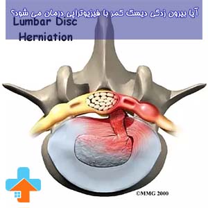 آیا بیرون زدگی دیسک کمر با فیزیوتراپی درمان می شود به این سوال در این محتوا اشاره می‌کنیم.با ما همراه باشید.