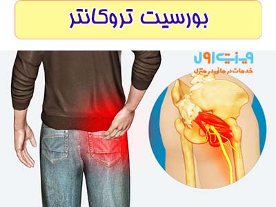 زمانی که بورس های کنار مفصل لگن التهاب پیداکنند بورسیت تروکانتر اتفاق می افتد