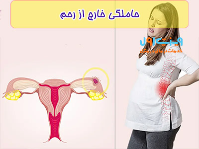 زمانی که حاملگی خارج از رحم اتفاق بیافتد با درد در ناحیه لگن همراه است.