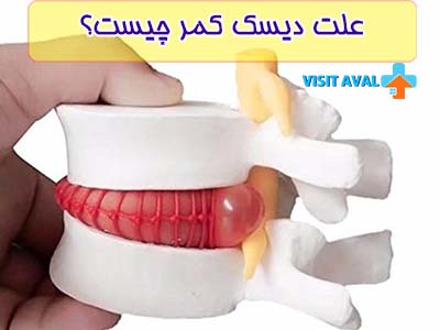 وقتی یک برآمدگی هایی در دیسک کمر به وجود می آید در اصطلاح دیسک کمر میگویند.