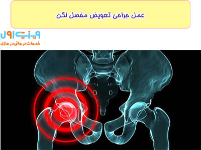 عمل جراحی تعویض مفصل لگن به منظور جایگزینی مفصل آسیب‌دیده با یک ایمپلنت مصنوعی انجام می‌شود و می‌تواند به طور چشمگیری درد و محدودیت حرکتی بیمار را کاهش دهد.
