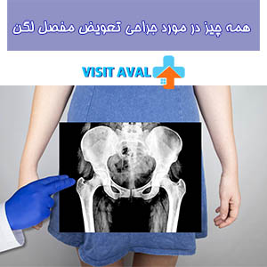 جراحی تعویض مفصل لگن یک روش موثر برای کاهش درد و بهبود عملکرد در بیماران مبتلا به مشکلات شدید مفصلی است.