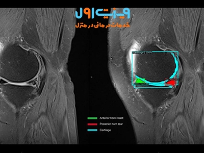 برای تشخیص پارگی مینیسک، پزشک علاوه بر معاینه فیزیکی، از روشهای تصویربرداری مانند M.R.I استفاده میکند تا میزان و نوع آسیب را بهدقت ارزیابی کند.