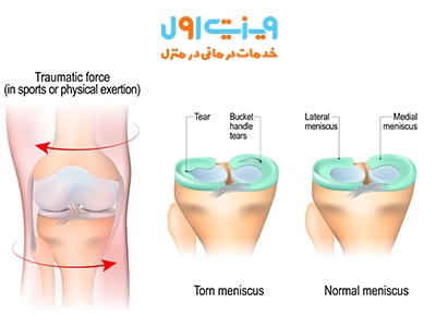 شناخت انواع مختلف پارگی مینیسک زانو، از آسیبهای پیچشی تا پارگیهای افقی و عمودی، به تشخیص دقیق و انتخاب روش درمان مناسب کمک میکند.