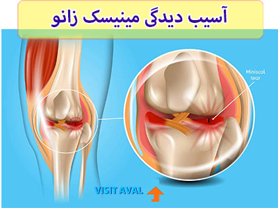 فیزیوتراپی آسیب دیدگی مینیسک زانو