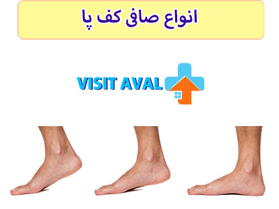 به طور کل دو نوه صاقی کف پا داریم، که در ادامه به آنها میپردازیم