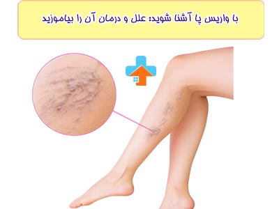 واریس پا یک مشکل ژنتیکی و یک بیماری است که به شدت پیشرفت می‌کند.