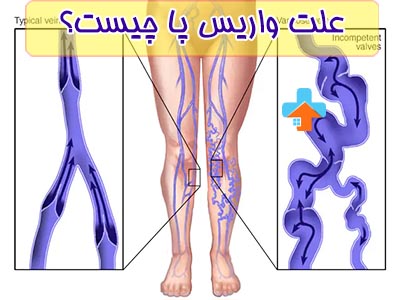 واریس پا به دلیل ضعیف بودن سیاهرگ در بدن به وجود می‌آید.