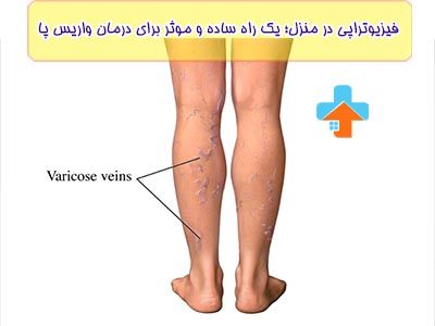 واریس پا به سیاه شدن رگ ها در پا می‌گویند که به مررو باعث درد و تورم در آن نواحی میشود.