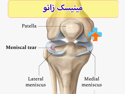 با بهرهگیری از تکنیکهای نوین در فیزیوتراپی پارگی مینیسک زانو، توانبخشی پا و بهبود عملکرد زانو به طور چشمگیری تسهیل میشود.