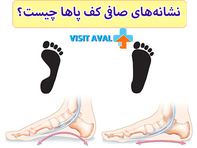 جالب است بدانید خیلی از افرادی که دارای کف پای صاف هستند، هیچ علائمی ندارن!