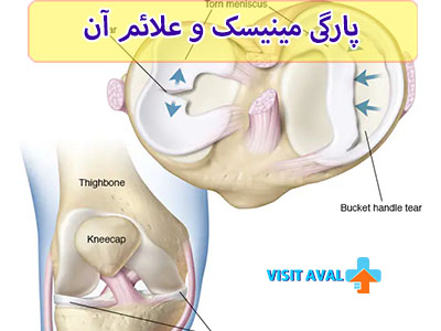 علائم پارگی مینیسک مانند درد حاد، تورم و کاهش دامنه حرکت در مفصل زانو، اغلب نشانههای هشداردهنده آسیب جدی به ساختار زانو محسوب میشوند.