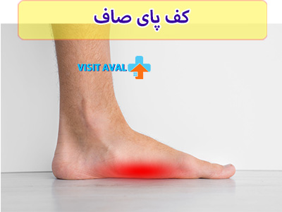 در اکثر مواقع کف پای صاف به صورت ارثی می‌باشد.