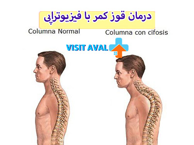 فیزیوتراپی می‌تواند به کاهش علائم قوز کمر کمک کند.