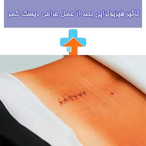 فیزیوتراپی پس از عمل جراحی دیسک کمر می‌تواند به بهبود سریع‌تر و موثرتر از علائم بیمار کمک کرده و زمان بازگشت به فعالیت‌های روزمره را کاهش دهد.