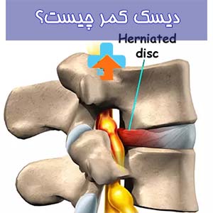 دیسک کمر به عنوان یک عامل مهم در درک مشکلات ناتوانی و درد، نه تنها با دلیل و علائم آن آشنا می‌شویم بلکه با اعمال روش‌های موثر درمانی، مسیری بهبود و تسکین را در پیش می‌گیریم.