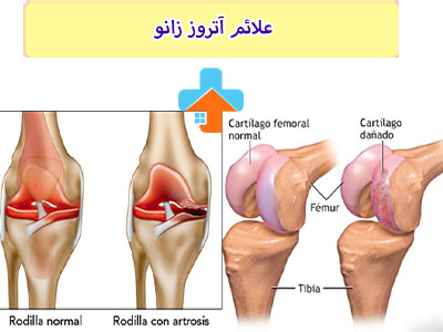علائم آتروز زانو؛ آرتروز زانو (Osteoarthritis of the Knee) عبارت است از یک بیماری مزمن و التهابی که به تدریج باعث تخریب غضروف‌های زانو می‌شود.