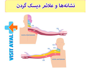 نشانه‌ها و علائم دیسک گردن ممکن است شامل درد و محدودیت حرکت گردن، اختلالات حسی و عضلانی شده و به مرور زمان تشدید یابند.