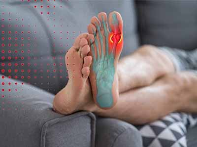 علائم خفیف نقرس معمولاً به شکل یک 'حمله نقرسی' آغاز می‌شوند و شامل درد و تورم مفصل متأثر، اغلب در انگشتان پا، که معمولاً با سرعت و شدت بالا همراه است.