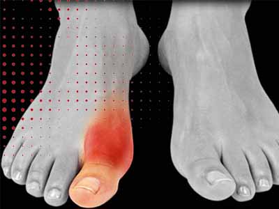 نقرس یک بیماری التهابی مفاصل است که معمولاً مفصل بزرگ پا (مفصل انگشتان پا) را تحت تأثیر قرار می‌دهد و می‌تواند با درد شدید و تورم ناگهانی همراه باشد.