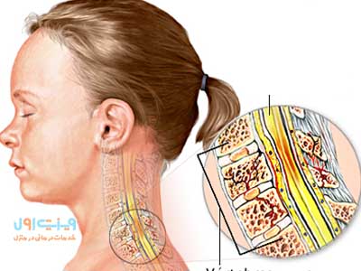 استفاده از فیزیوتراپی برای مدیریت و درمان بهتر آسیب‌های نخاعی با تمرکز خاص بر ضایعات نخاعی گردن.