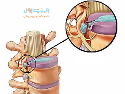 پارگی دیسک کمر، یک وضعیت پر درد و ناراحتکننده است که نیاز به تشخیص دقیق و برنامه درمانی مناسب دارد تا بهبودی و کاهش درد بیمار را فراهم کند.