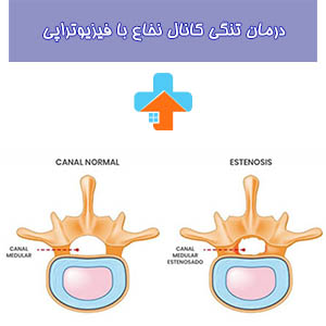 تجربه فیزیوتراپی تنگی کانال نخاع با دسترسی به امکانات پیشرفته و تکنولوژی مدرن، به شما در بهبود و درمان مشکلات تنگی کانال نخاع کمک می‌کند.