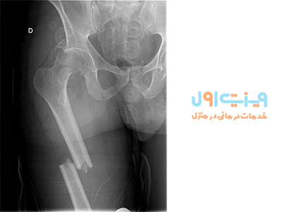 شکستگی استخوان ران ممکن است ناشی از افتادن، ضربه و تصادفات باشد، حتی با وجود اینکه استخوان ران به عنوان قوی‌ترین استخوان بدن شناخته می‌شود.