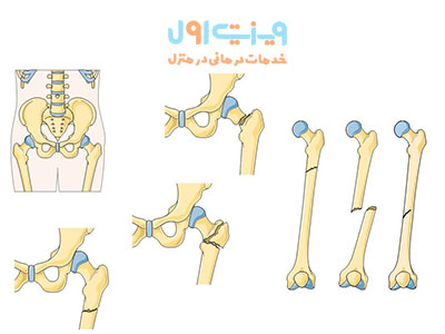 انواع شکستگی استخوان ران شامل شکستگی گردن ران، شکستگی اینترتروکانتریک و شکستگی استخوان ساب تروکانتریک است که هرکدام نیاز به روش‌های درمانی متفاوتی دارند.