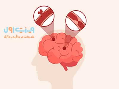 دلایل بروز سکته مغزی میتواند شامل عواملی همچون سن، فشار خون نامناسب، و بیماریهای قلبی و عروقی باشد.