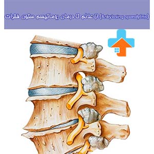روماتیسم ستون فقرات، به‌ویژه اسپوندیلیت آنکیلوزان، می‌تواند باعث سفتی و درد شدید شود که با فیزیوتراپی روماتیسم ستون فقرات، می‌توان این علائم را کاهش داد و حرکت‌پذیری را بهبود بخشید.