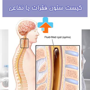 کیست ستون فقرات ممکن است به عنوان یک کیست نخاعی شناخته شود که بر عملکرد عصب‌های مجاور تأثیر می‌گذارد.