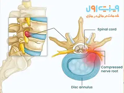علت پارگی دیسک کمر می‌تواند ضعف عضلات پشتی یا بارز شدن دیسک به دلیل فشار طولانی مدت بر ستون فقرات باشد.