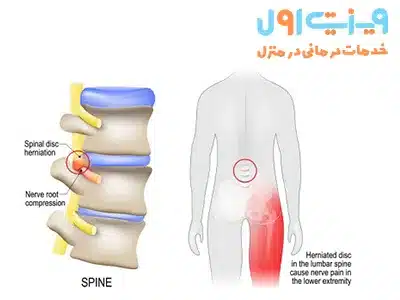 تشخیص دیسک کمر از سیاتیک معمولاً با بررسی تاریخچه پزشکی بیمار و ارزیابی علائم بالینی انجام می‌شود.