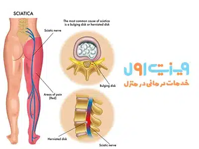 تشخیص درد سیاتیک با دیسک کمر نیازمند ارزیابی دقیق علائم بالینی و تاریخچه پزشکی بیمار برای شناسایی بیرون‌زدگی دیسک کمر به‌عنوان یک عامل احتمالی است.