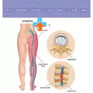 فرق دیسک کمر با سیاتیک این است که در دیسک کمر، مشکل اصلی معمولاً ناشی از فشرده شدن دیسک‌های بین مهره‌ای است، در حالی که سیاتیک به تحریک عصب سیاتیک منجر می‌شود.