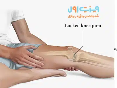قفل شدن زانو میتواند نشانهای از پارگی غضروفی باشد که باعث درد و محدودیت حرکت در مفصل زانو میشود.