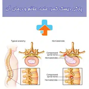 پارگی دیسک کمر معمولاً به دلیل فشار بیش از حد به ستون فقرات، بلند کردن اجسام سنگین یا حرکات نادرست ایجاد می‌شود.